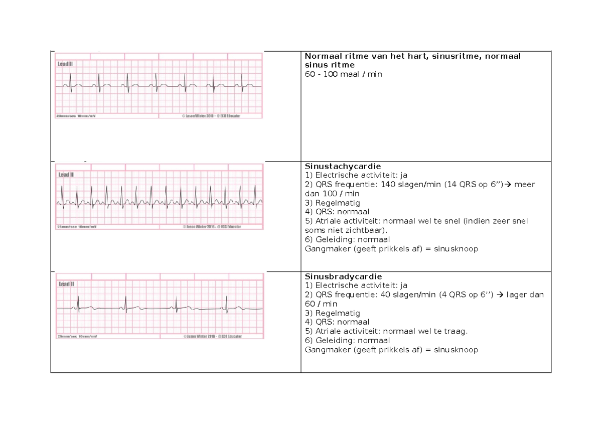 Flashcards ECG - Normaal ritme van het hart, sinusritme, normaal sinus ...