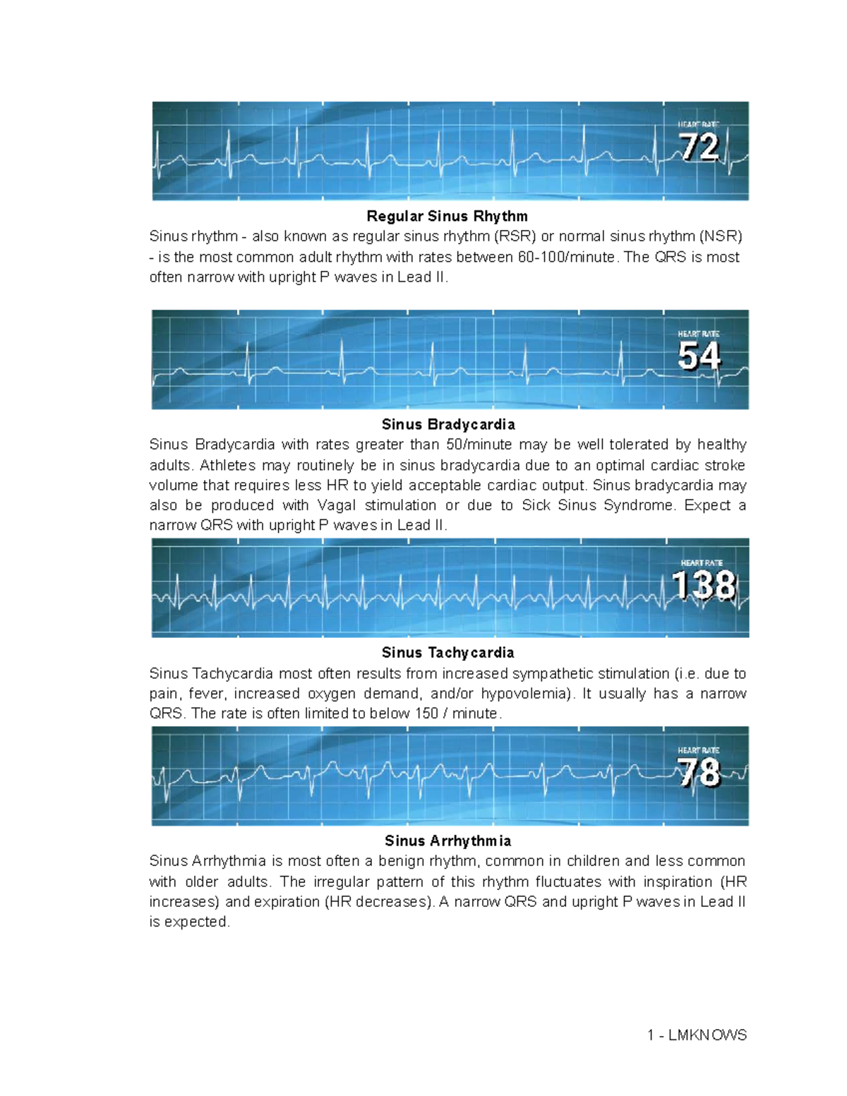 ECG Interpretations: Understanding Sinus Rhythms and Blocks - Studocu