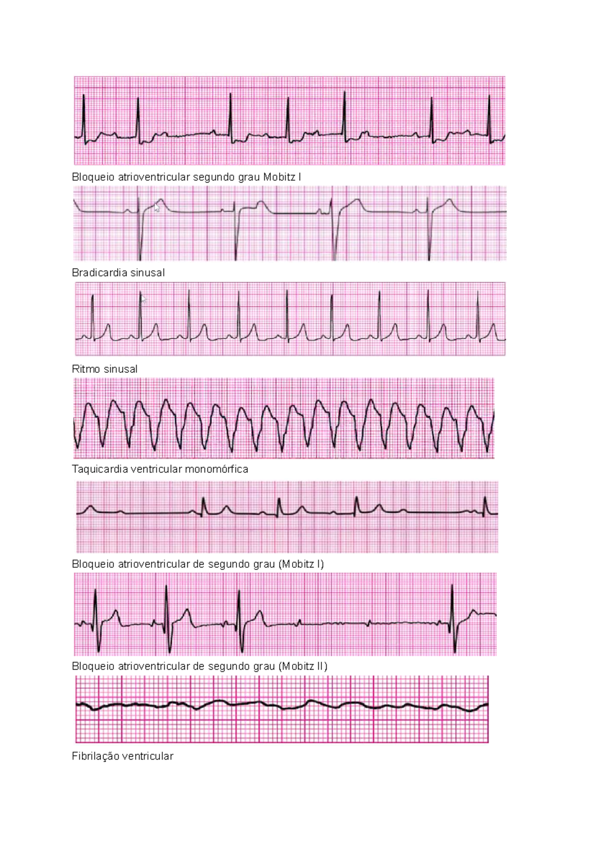 ACLS - Ritmos e Intervenções em Emergências Cardiovasculares - Studocu