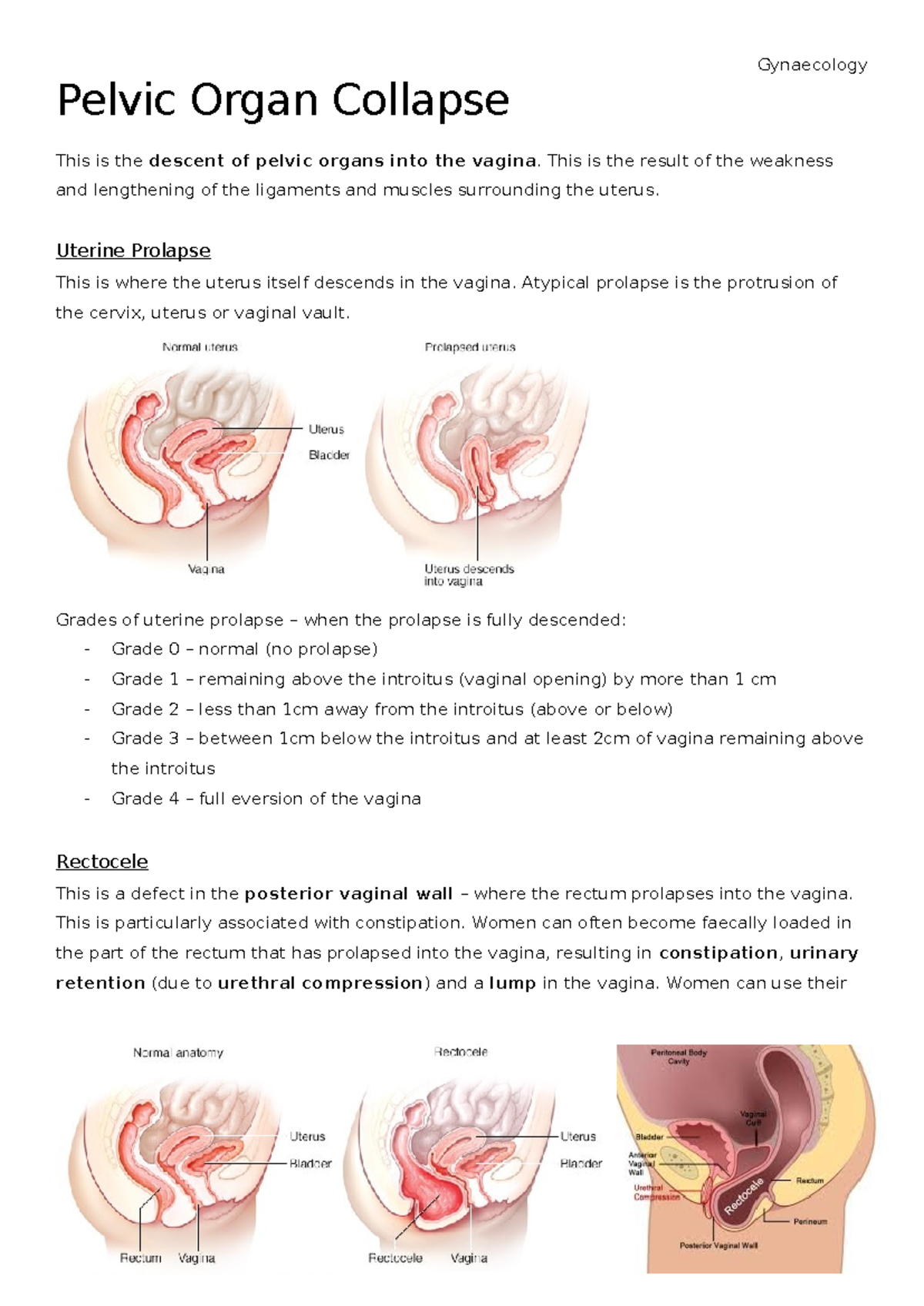 Gynaecology Pelvic Organ Collapse - Gynaecology Pelvic Organ Collapse ...