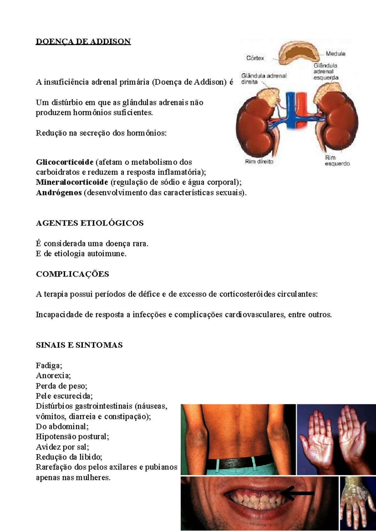Doenca De Addison Adrenal Insufficiency (Addison's Disease) | Johns