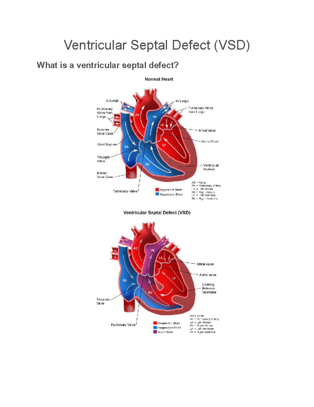 Ventricular Septal Defect (VSD): Overview, Types, Symptoms & Treatment ...