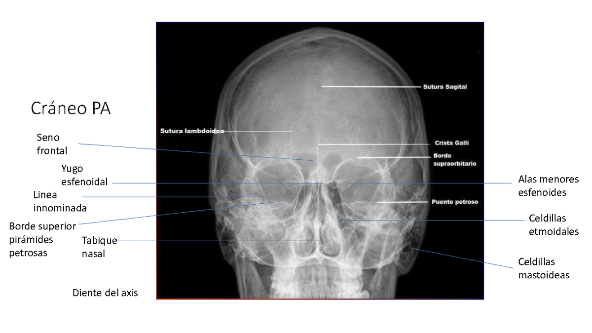 1 - anatomia radiologica craneo pa - anatomía radiológica - Cráneo PA ...
