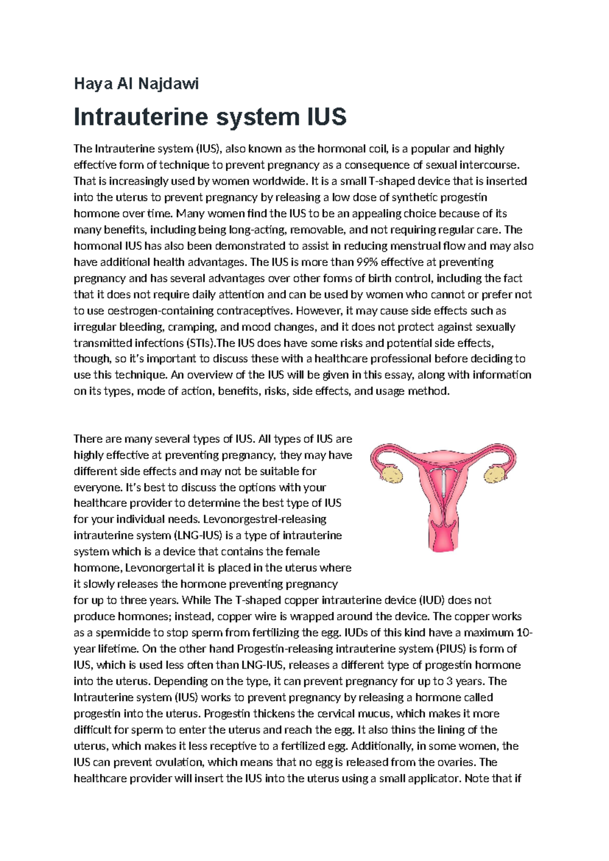 Intrauterine System (IUS) in Gynecology: Benefits and Risks Analysis ...