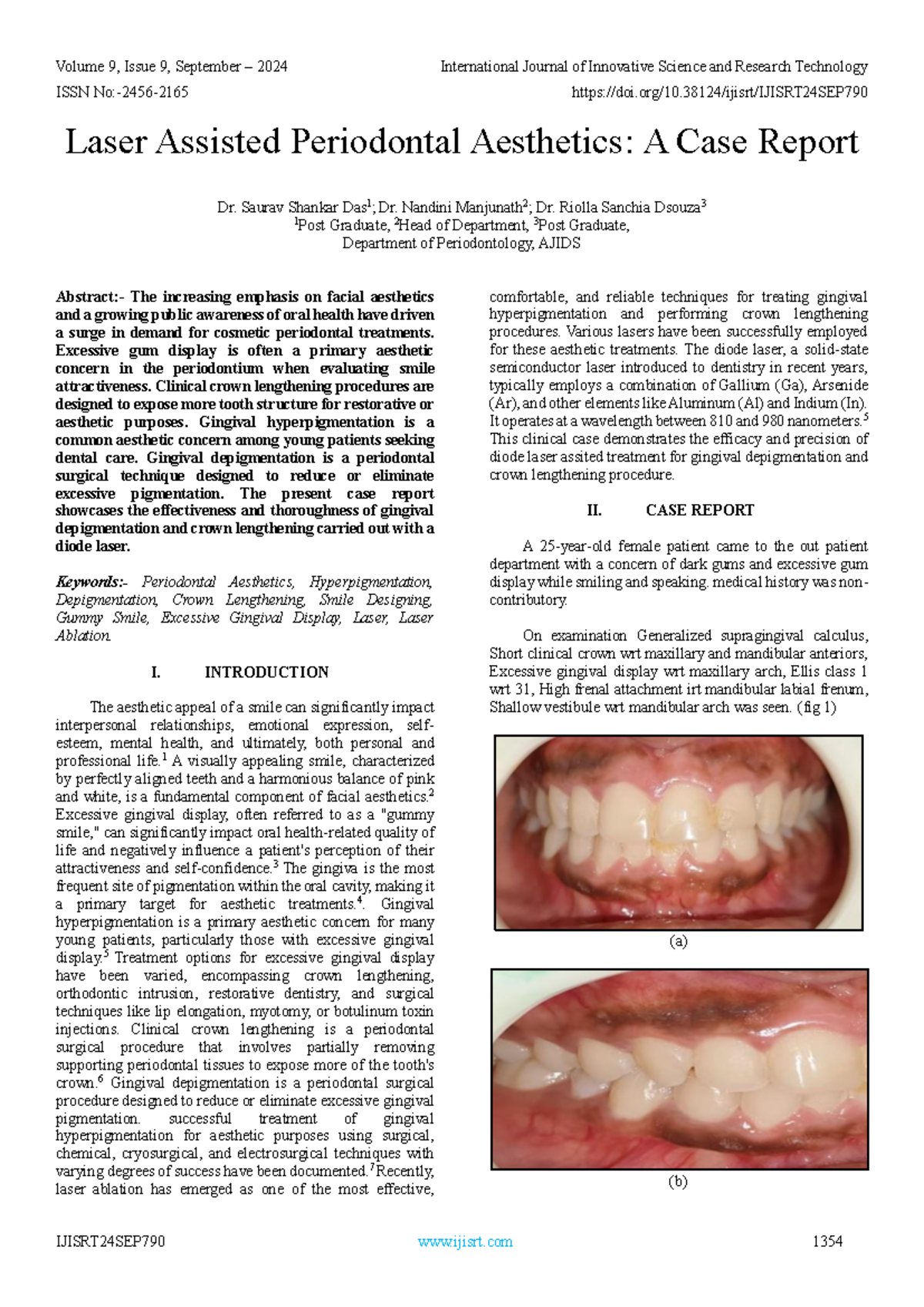 IJISRT24SEP790 - Laser-Assisted Periodontal Aesthetics: Case Study ...