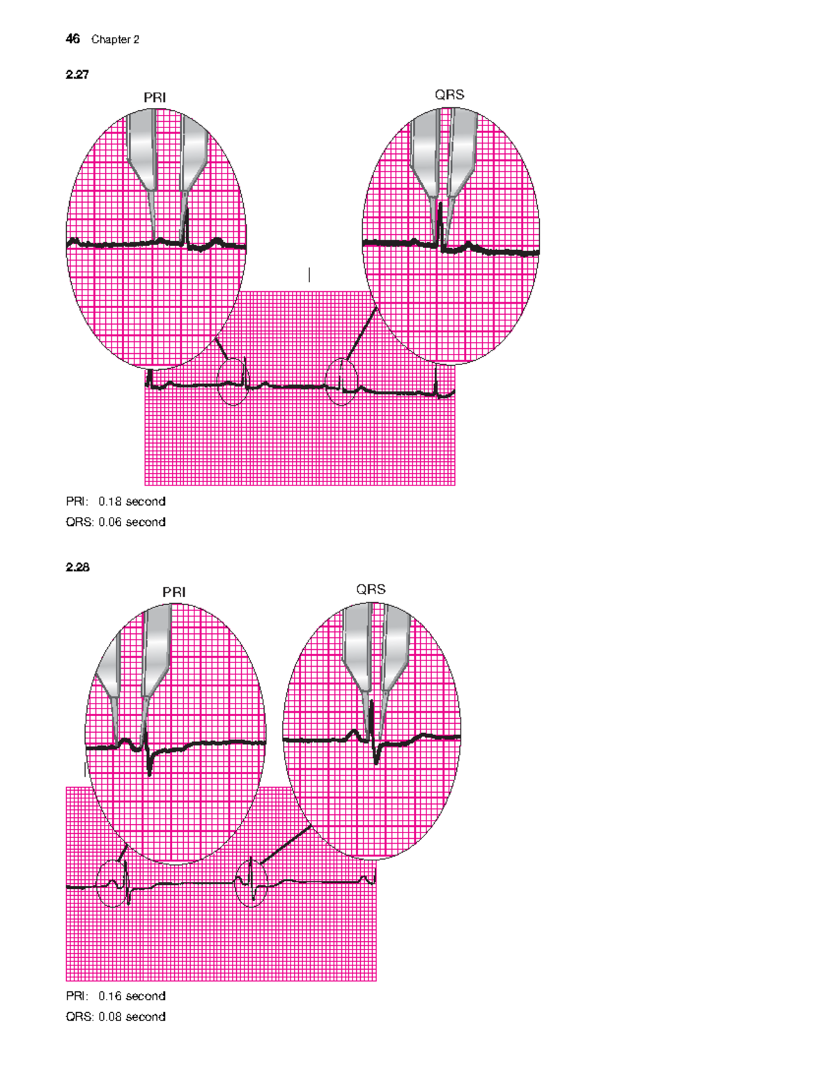 Analysis of EKG Rhythm Strips: Atrial & Sinus Arrhythmias (Course Code ...