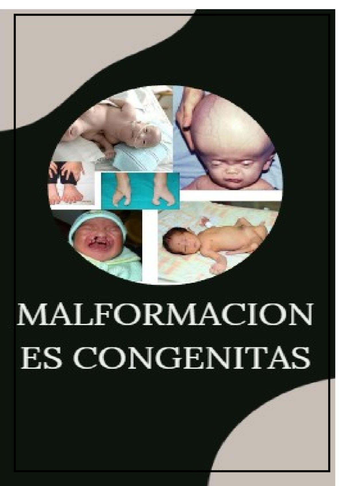 Informe sobre Malformaciones Congénitas - Medicina UDABOL 1er Semestre ...