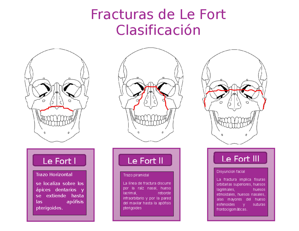 Fracturas Le Fort, H.Principales y Faringe - Fracturas de Le Fort ...