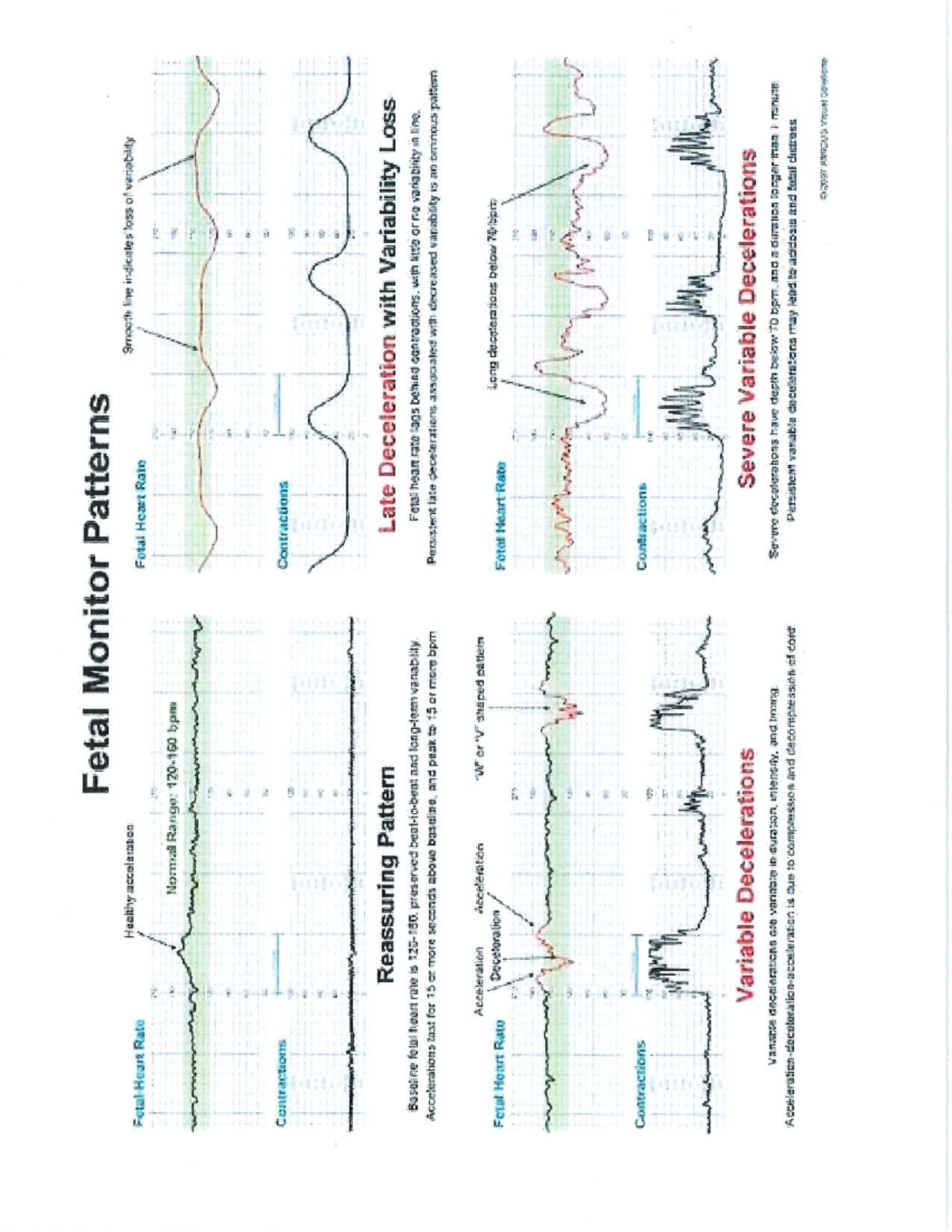 Fetal Monitor Patterns: Understanding Heart Rate Variability and ...