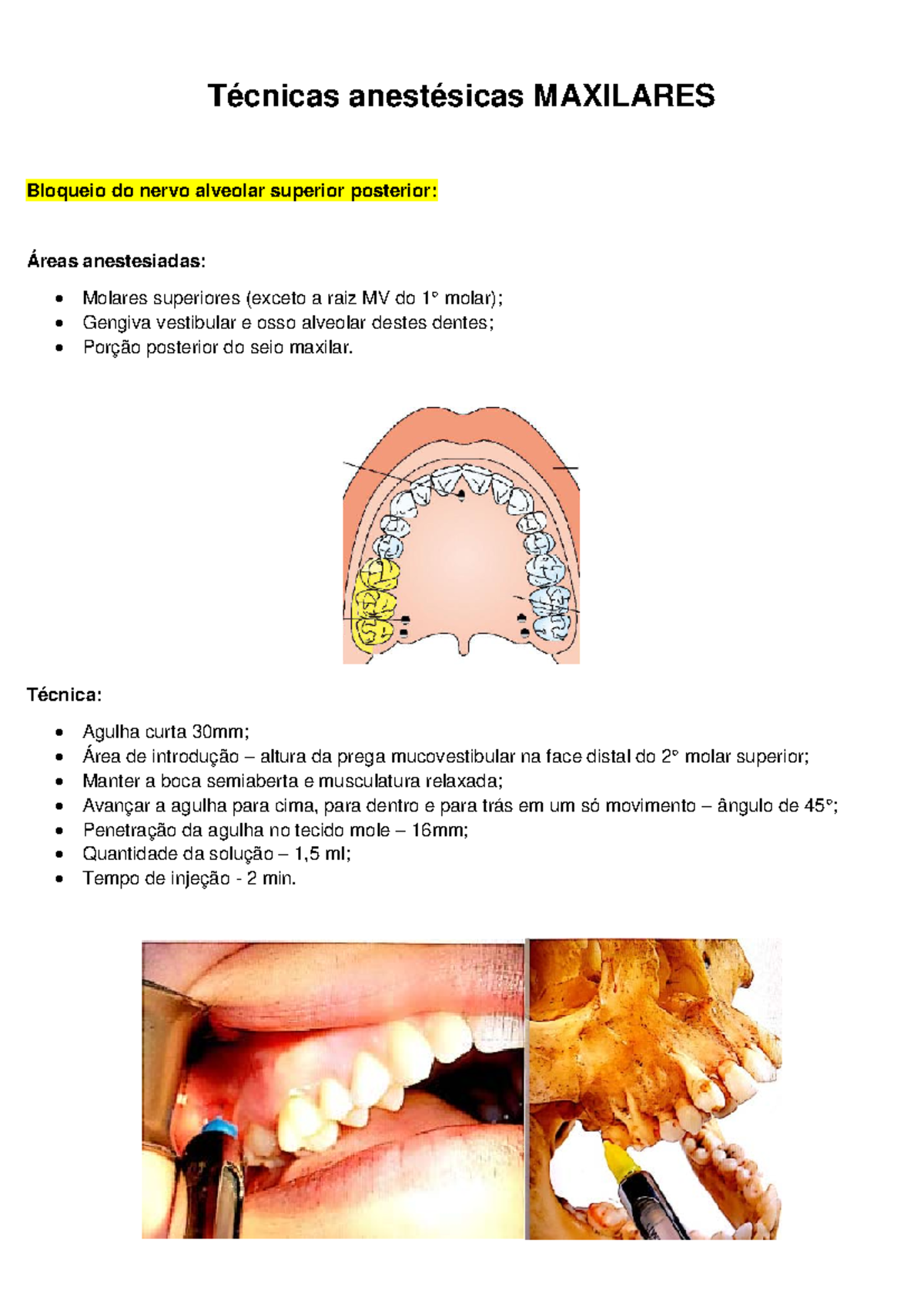 Técnicas de Anestesia Mandibular e Maxilar - Resumo Detalhado - Studocu
