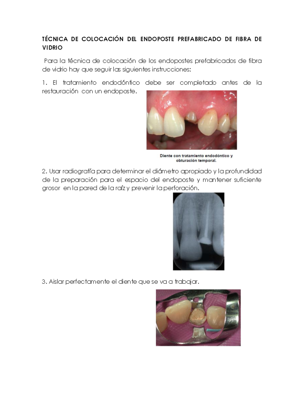 Técnica de Colocación del Endoposte Prefabricado de Fibra de Vidrio ...