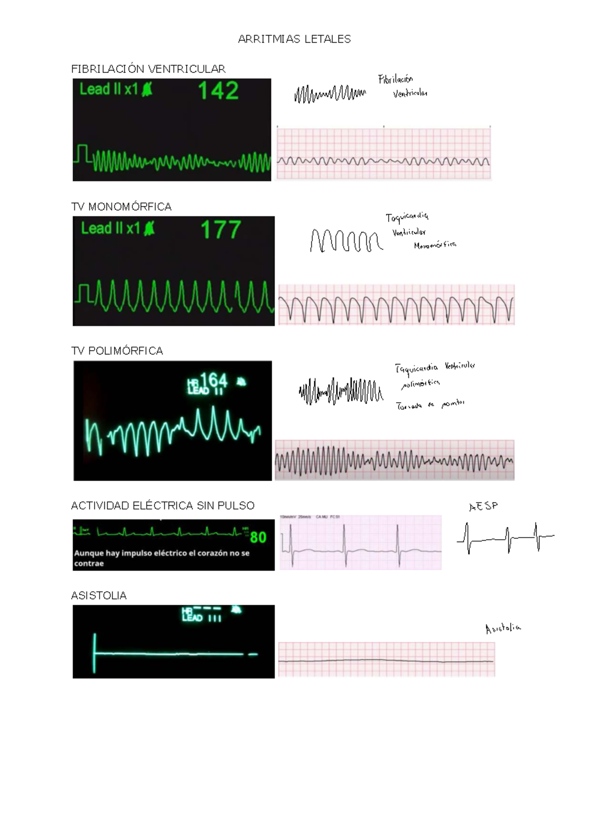 ACLS - Protocolo de Manejo de Arritmias Letales y Taquicardias - Studocu