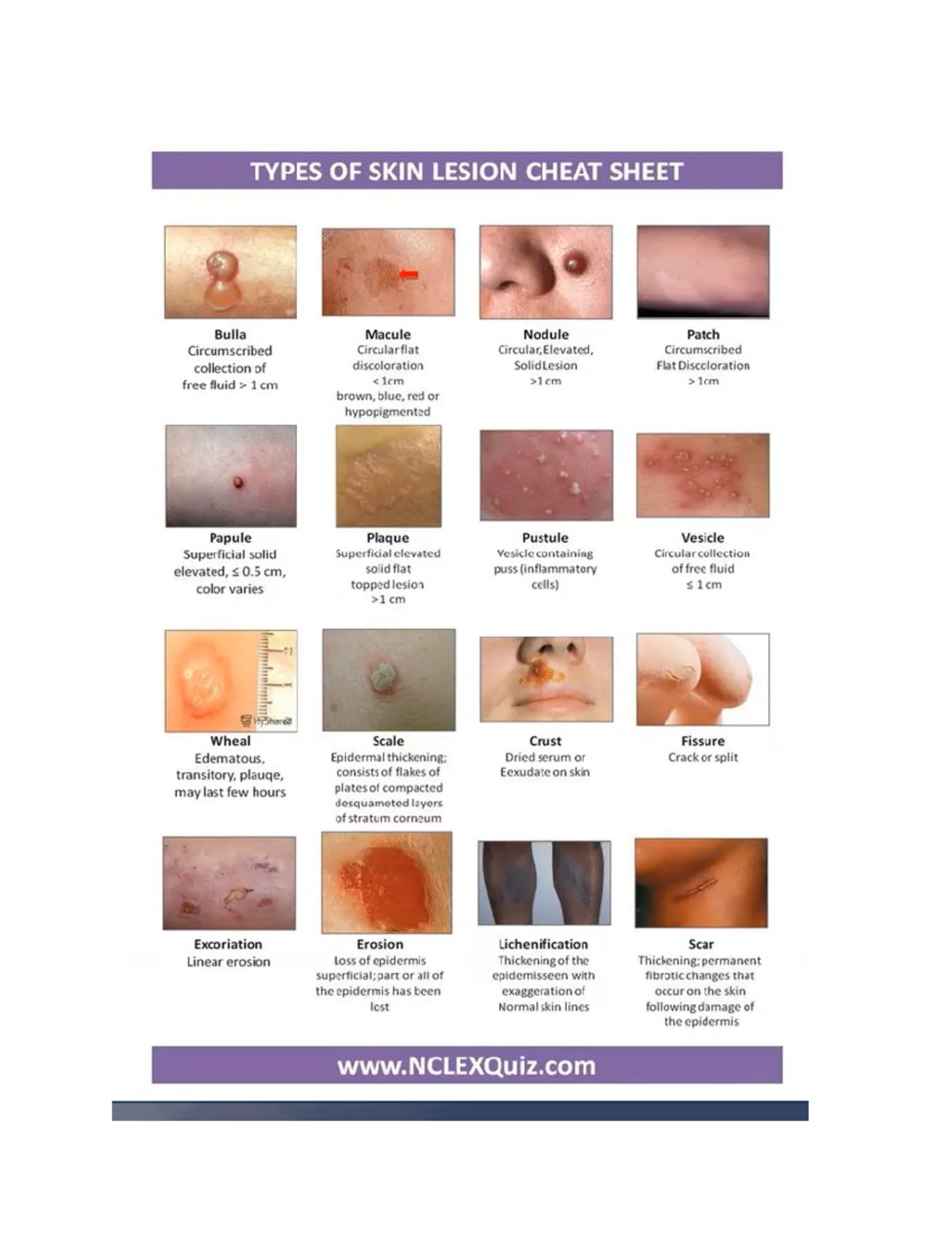 Types Of Pigmented Lesions - Infoupdate.org