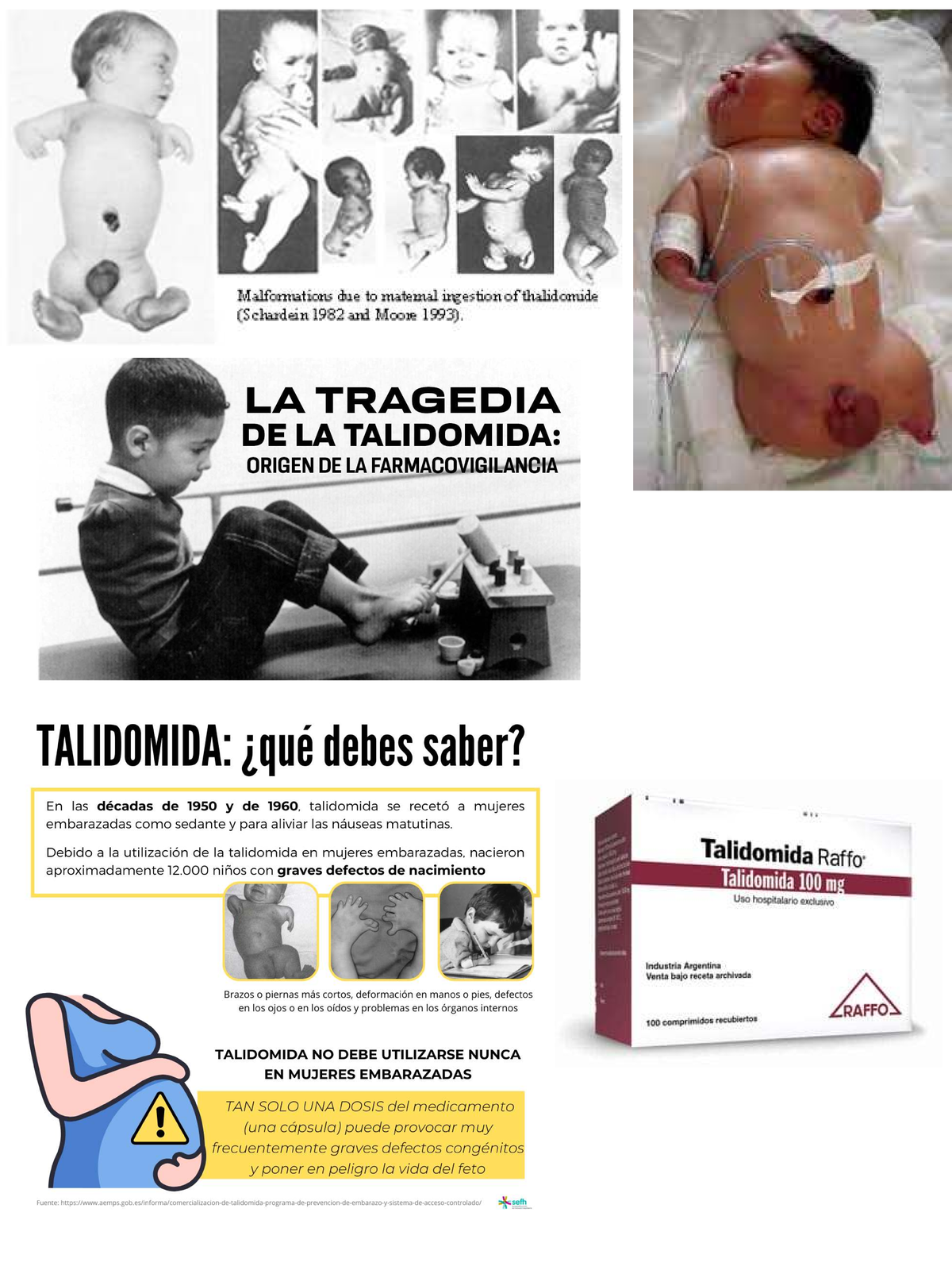 Malformaciones por Talidomida en Embarazo: Estudio de Caso (Gine y Onco ...