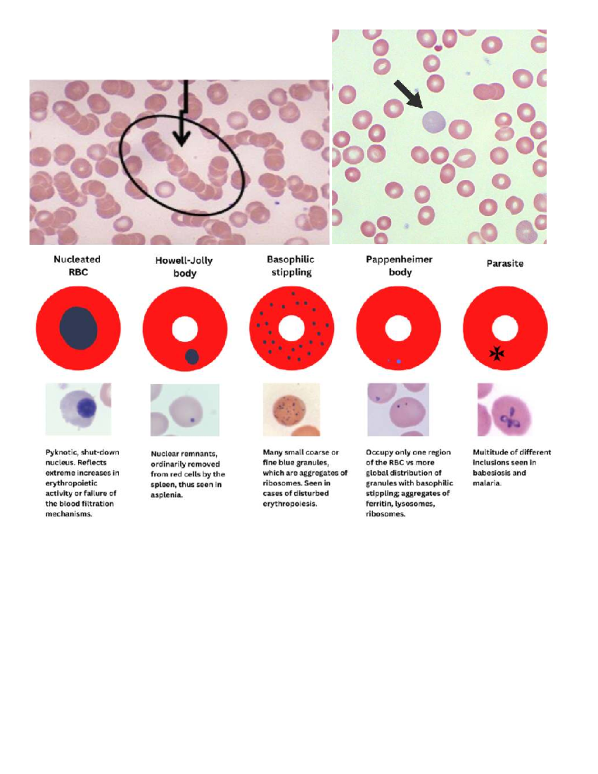 Haematology Study: Nucleated Basophilic Pappenheimer Parasite RBCs ...