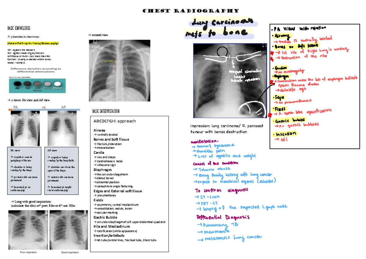 Edema - Comprehensive Notes on Mechanisms and Examples - Studocu