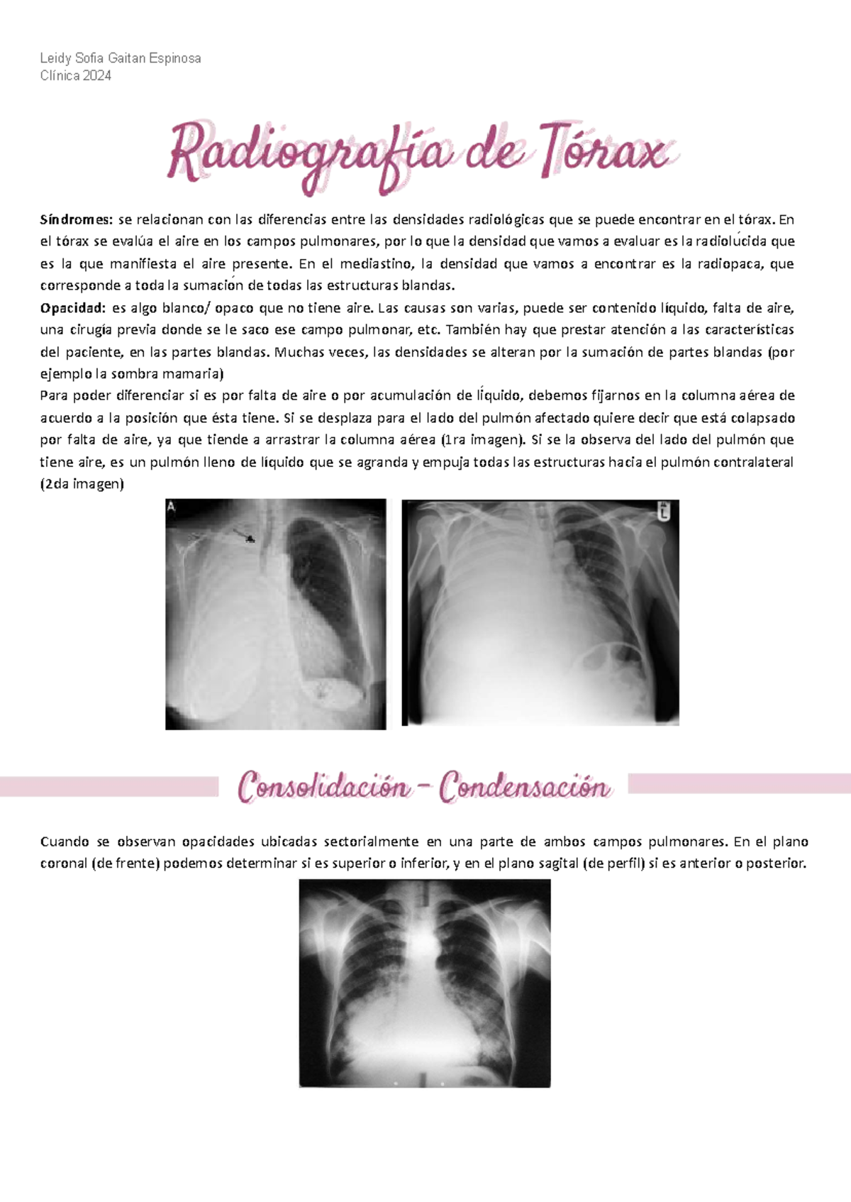 Rx de Tórax: Análisis de Densidades Radiológicas y Patologías - Studocu