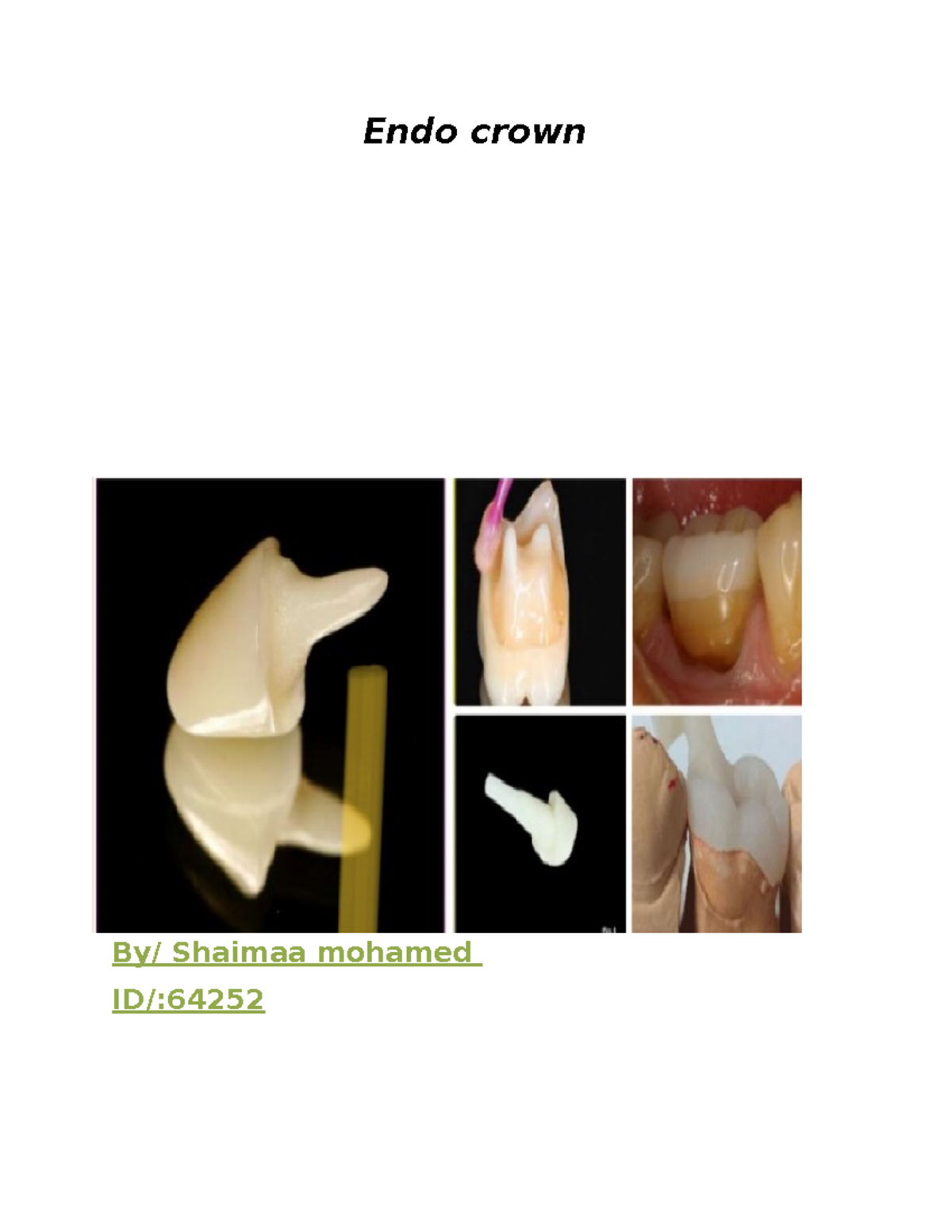 Copy of Endo crown - Endo crown By/ Shaimaa mohamed ID/: Definition The ...