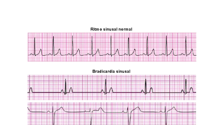 Ritmos cardíacos - Cardio - Clínica Médica - Ritmo sinusal normal ...