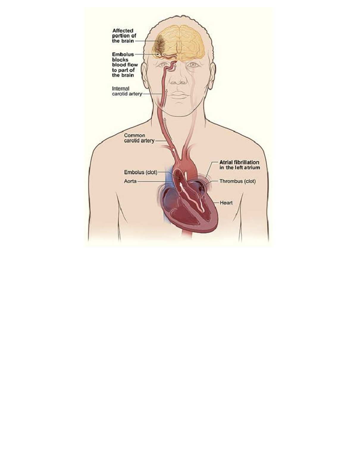 Stroke image - notes - PHED 1101 - Affected portion of the brain ...