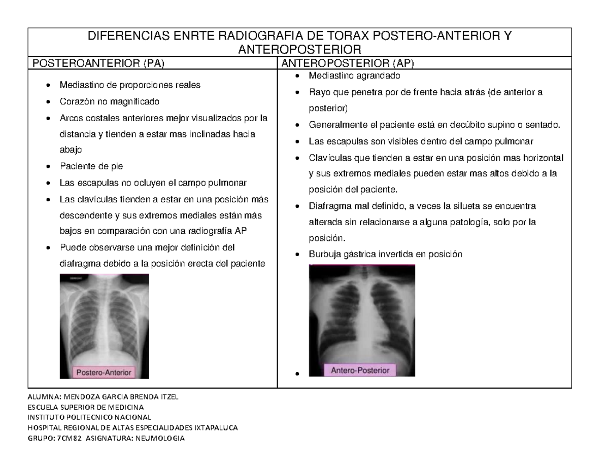 Diferencias en Radiografías de Tórax PA y AP - Neumología 7CM82 - Studocu