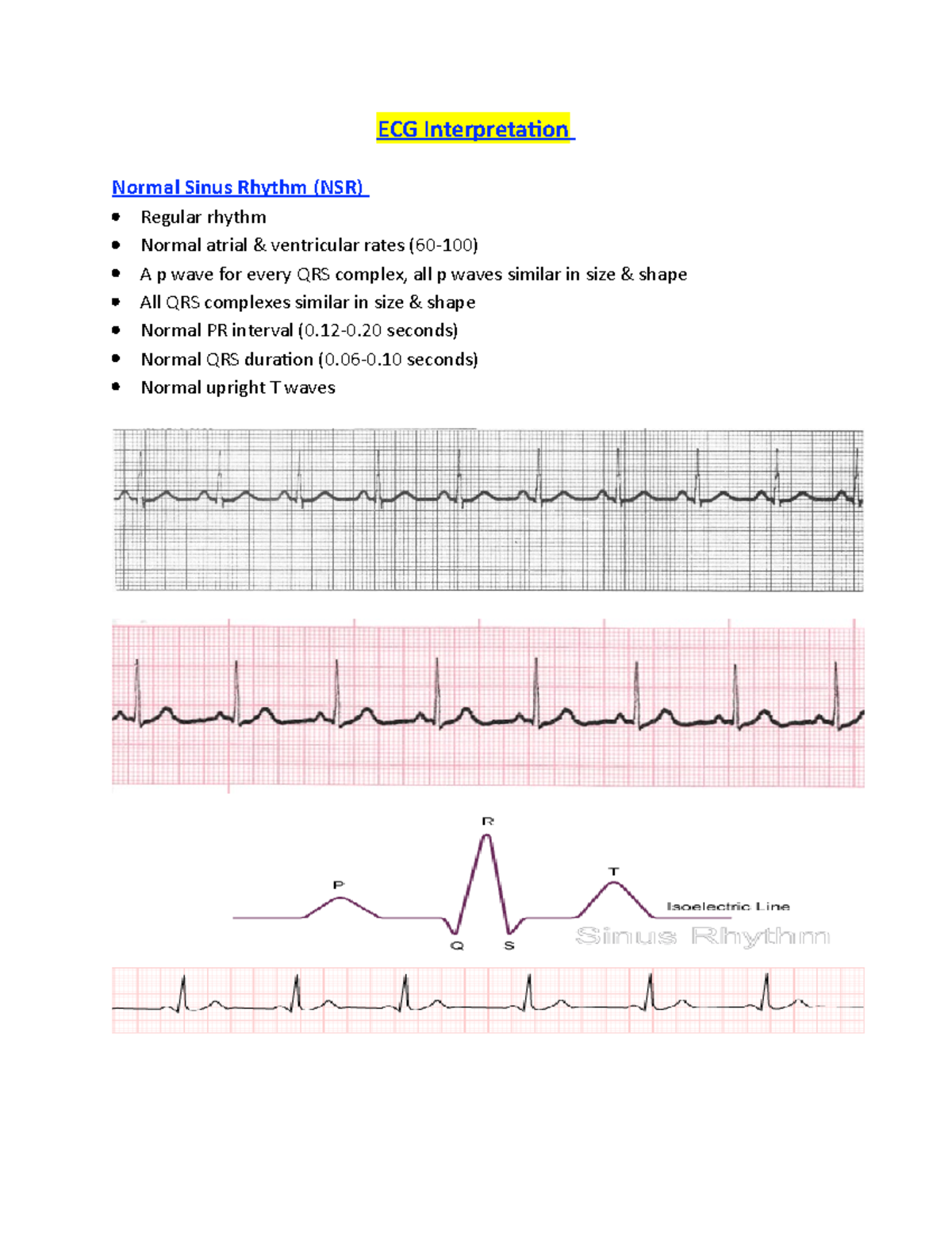 Normal Ecg Reading Pr Interval