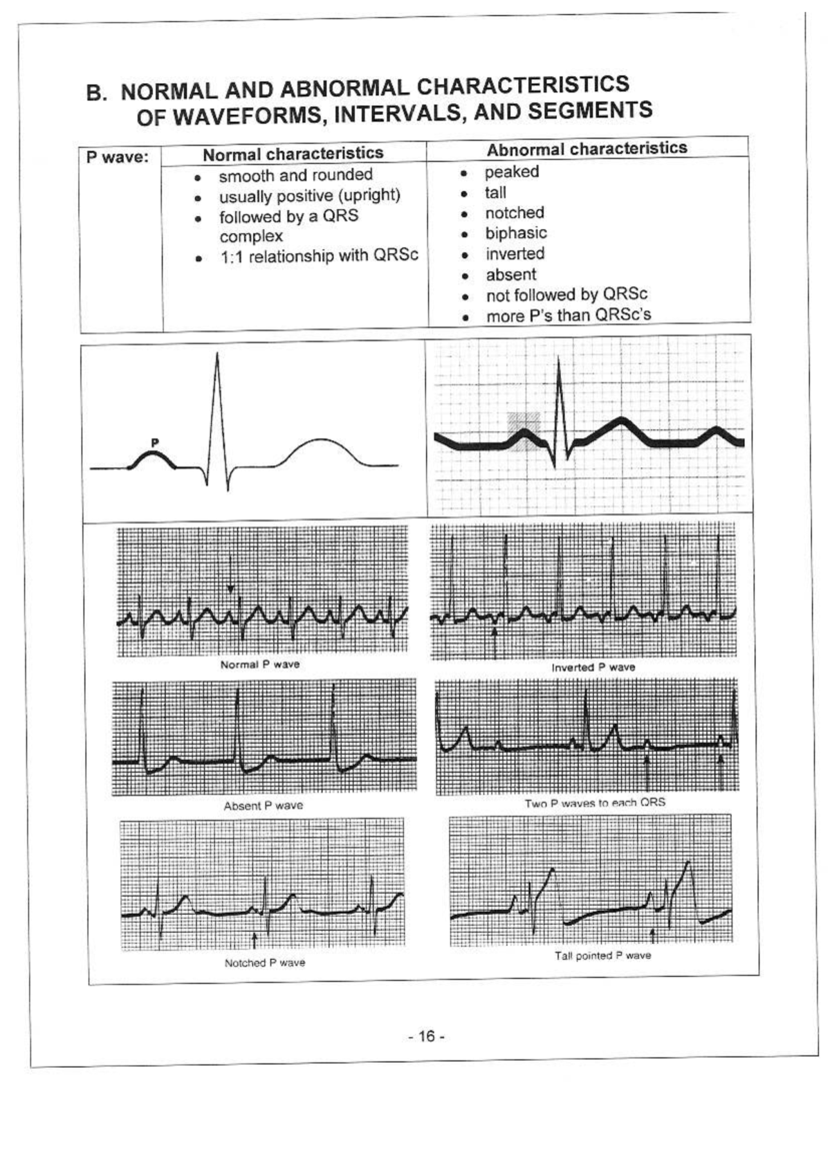 B. EKG WAVEFORMS: NORMAL & ABNORMAL CHARACTERISTICS AND INTERPRETATION ...