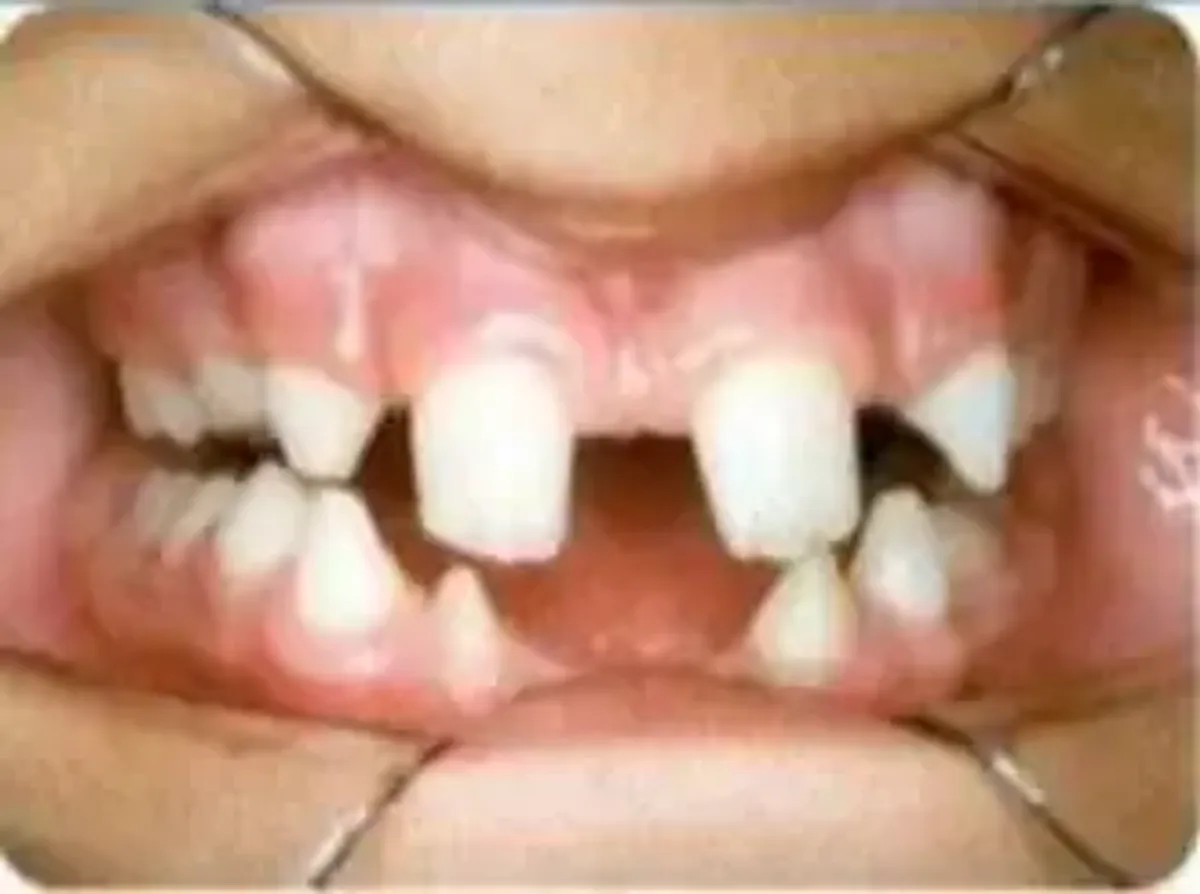 Anomalías Dentarias: Definición, Etiología y Características Clínicas - Document Preview