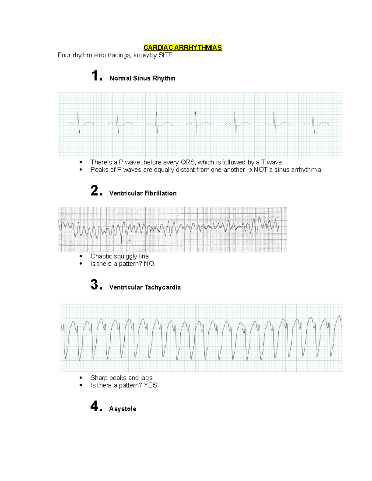 Cardiac Arrhythmias Study Notes for NCLEX Preparation - Studocu