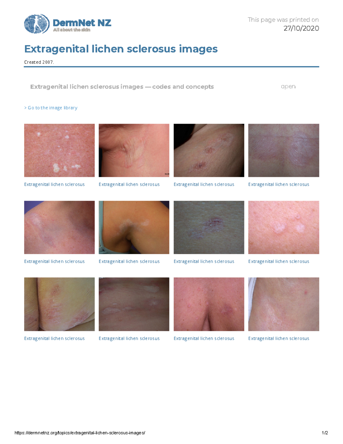 cigarette paper skin appearance lichen sclerosus A folliculocentric variant of extragenital presenting in a 29-year-old man Hey, beautiful soul.  Today