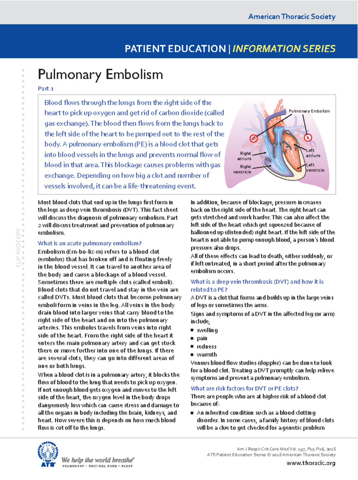 ATS Patient Education: Understanding Pulmonary Embolism (PE) Part 1 ...