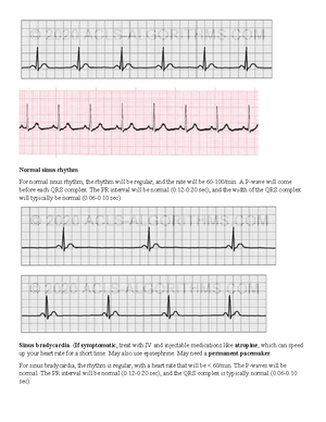 Rhythm strip practice - Study - Second-degree heart block type II. For ...