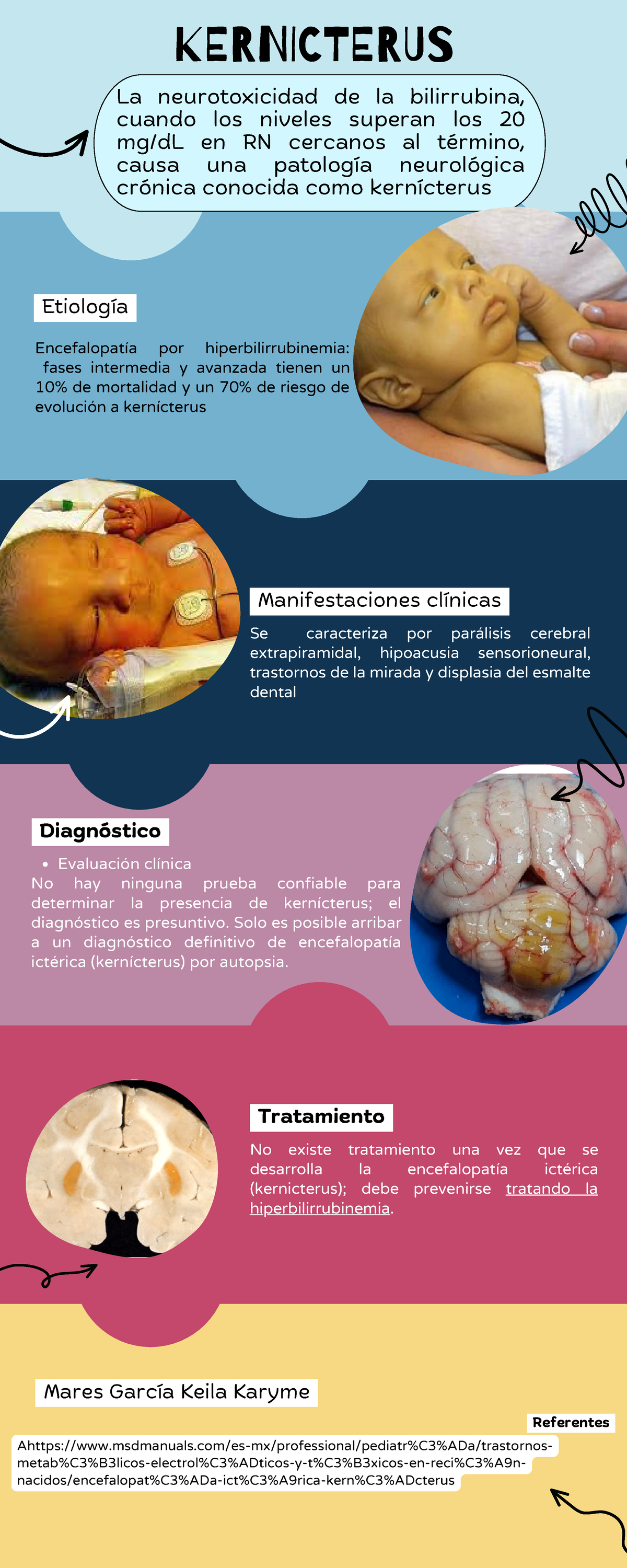 Kernicterus: Neurotoxicidad de Bilirrubina en RN - Causas y Tratamiento ...