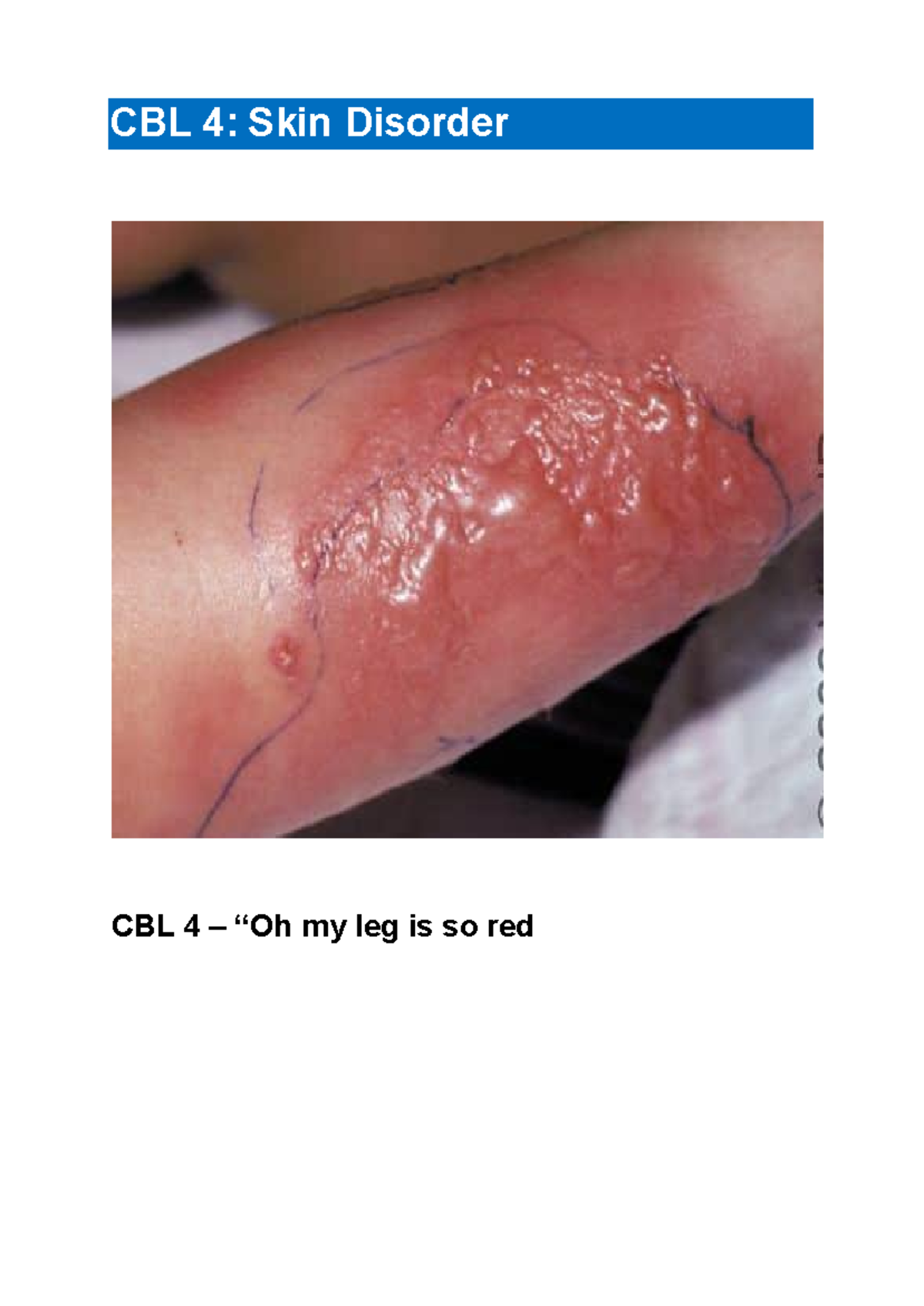 CBL 4: Comprehensive Study on Cellulitis and Nursing Management - Studocu