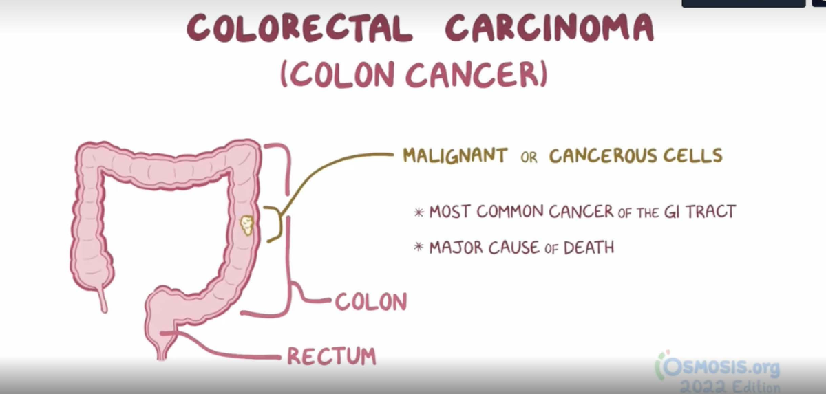 COLORECTAL CANCER (COLON CANCER) OVERVIEW & TREATMENT NOTES - Studocu