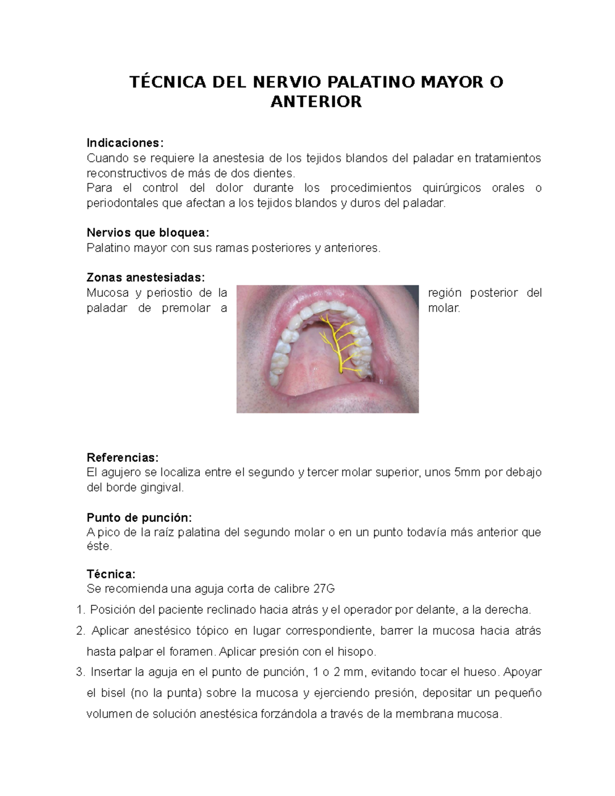 Técnica de Anestesia del Nervio Palatino Mayor en Odontología - Studocu