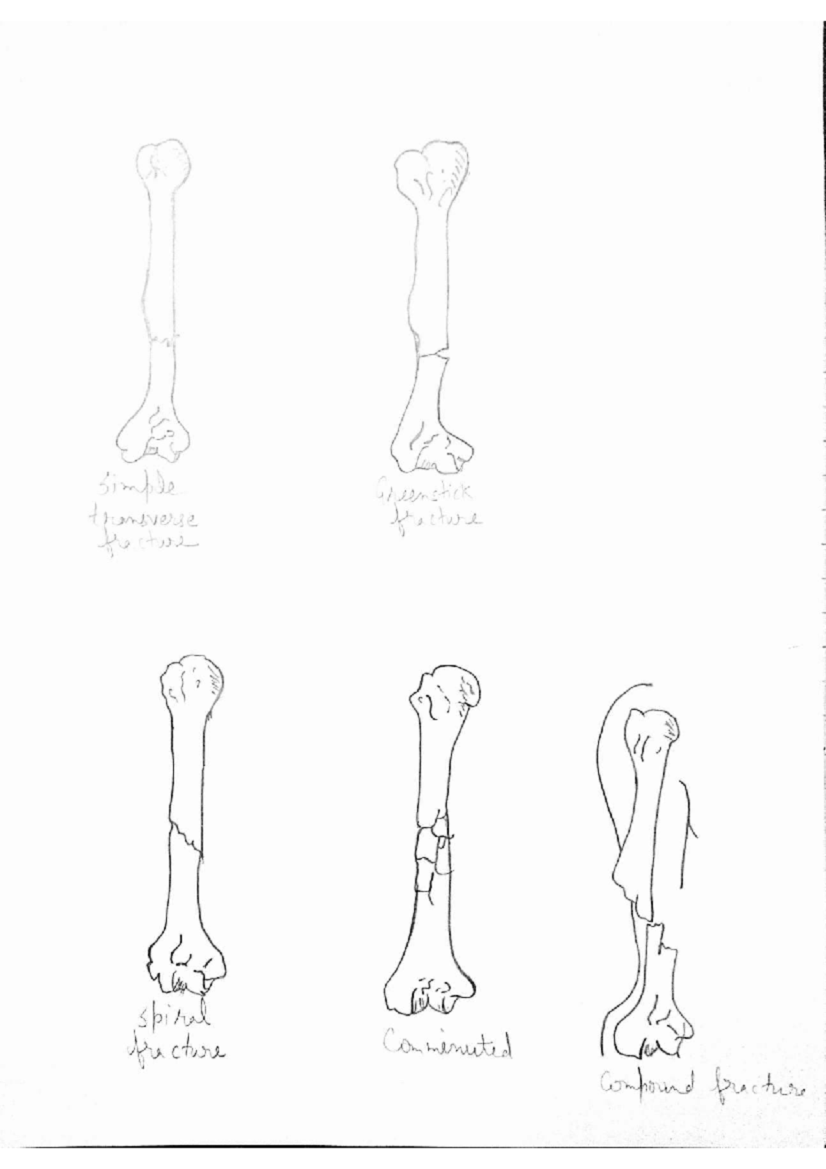 Bio 3 types of fractures and bone changes due to heat exposure studocu
