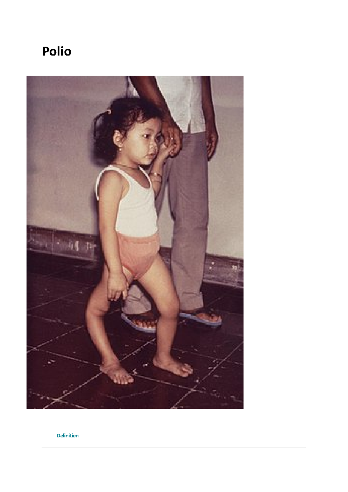 Polio - Comprehensive Notes on Definition, Symptoms, and Prevention ...
