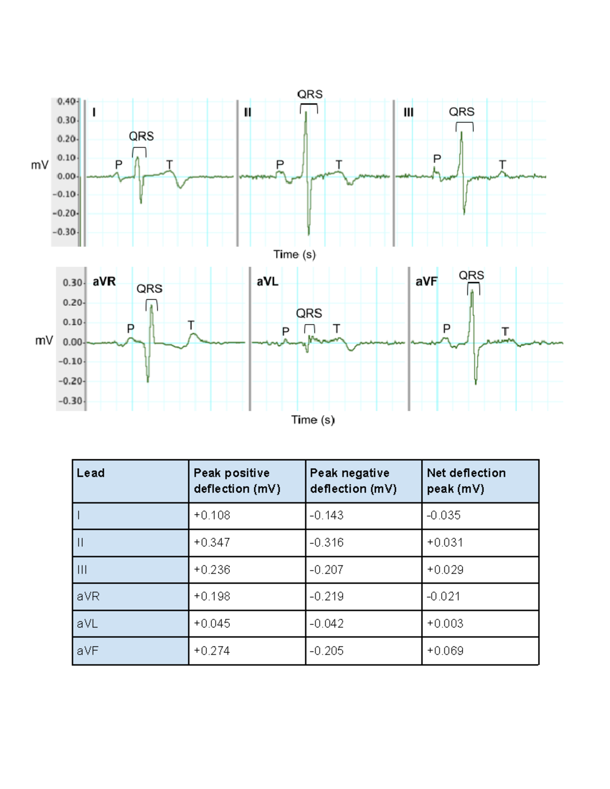 Medsci 205 ECG lab reuslts - The Physiology of Human Organ Systems ...