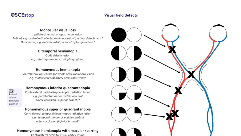 SCEstop Visual Field Defects: Monocular & Homonymous Losses - Studocu