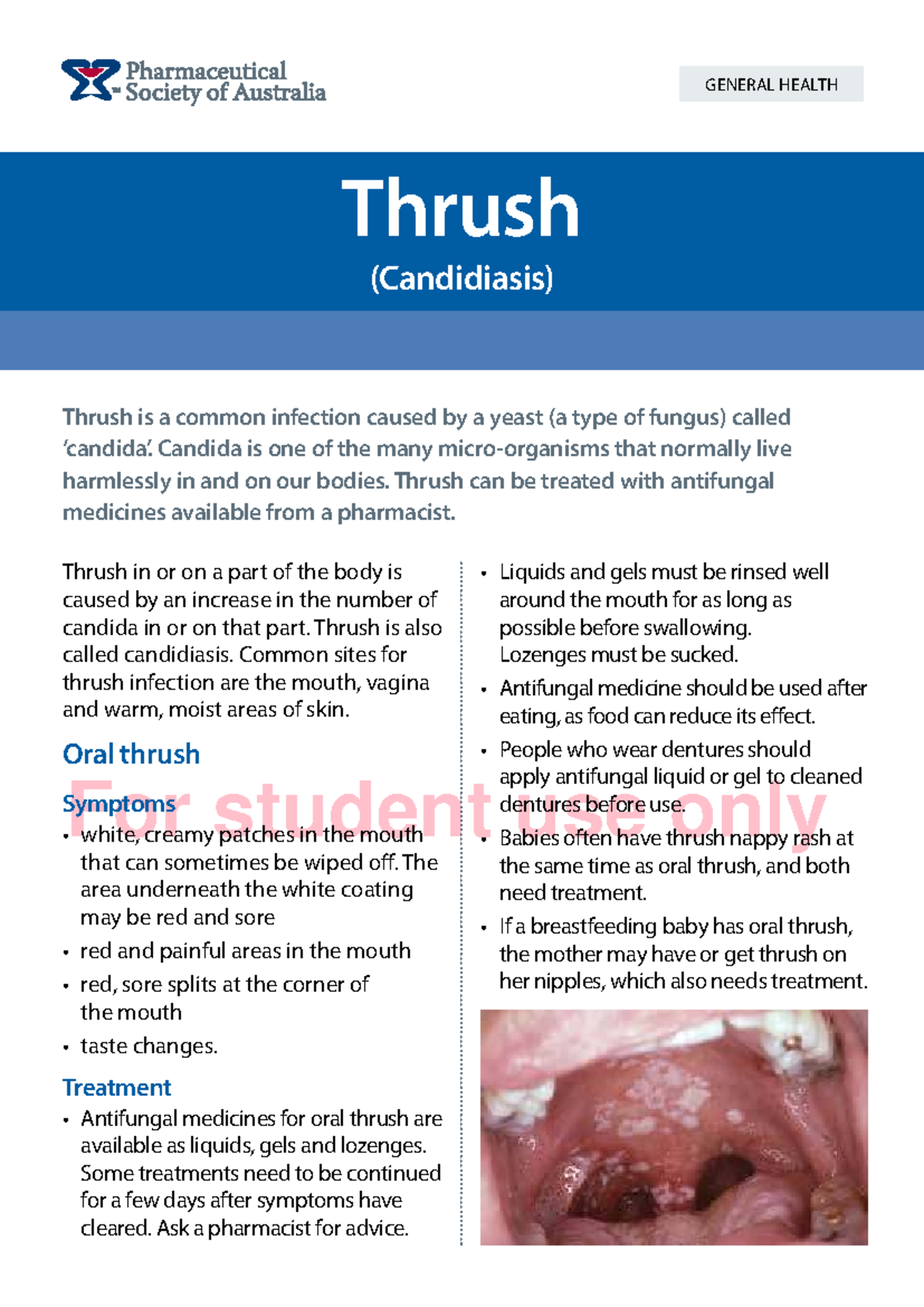 Thrush (Candidiasis) Overview and Treatment Guide - Studocu