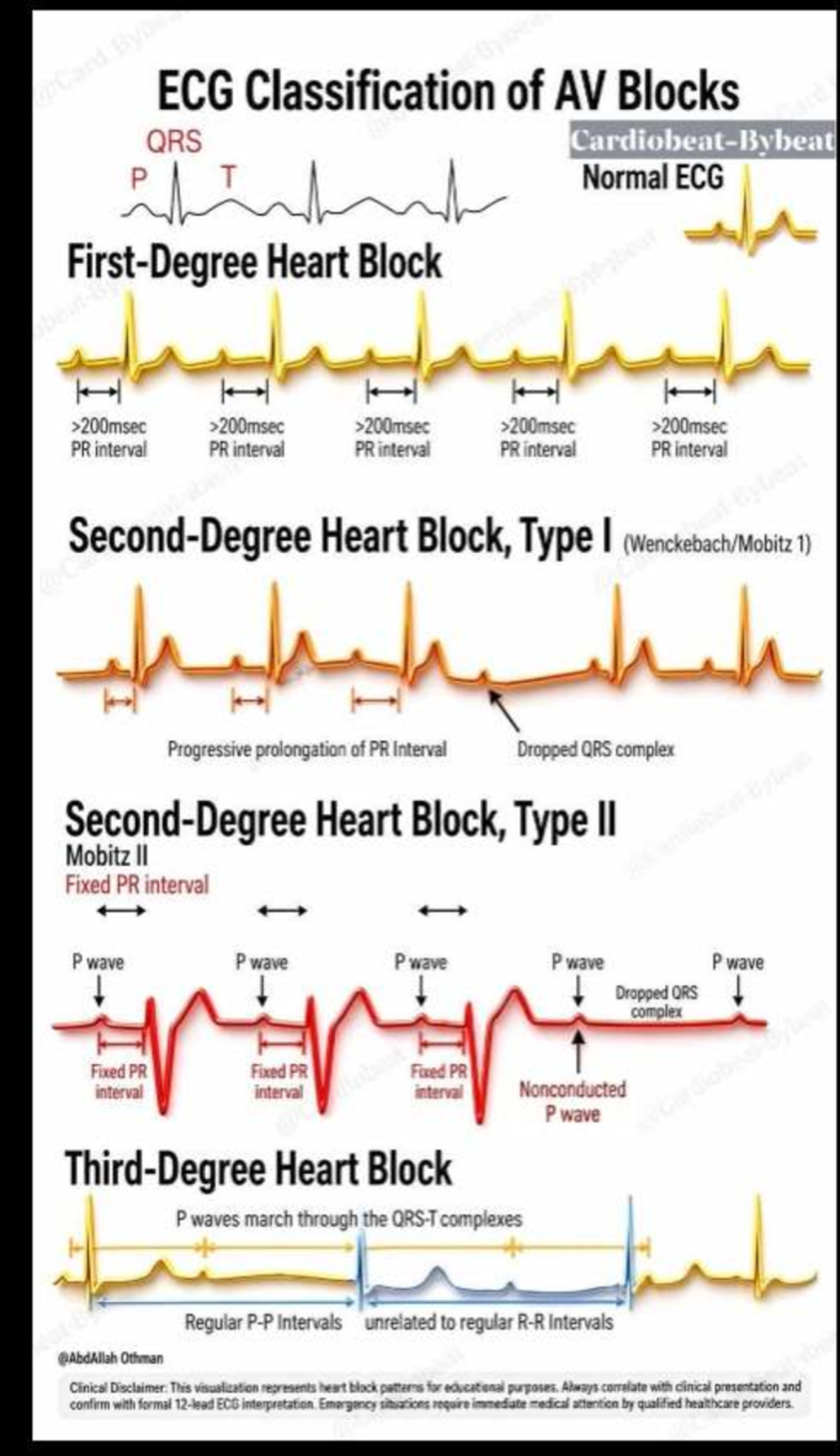 Screenshot 2026-04-24 at 2.30.01 PM - ECG Classification of AV Blocks i ...