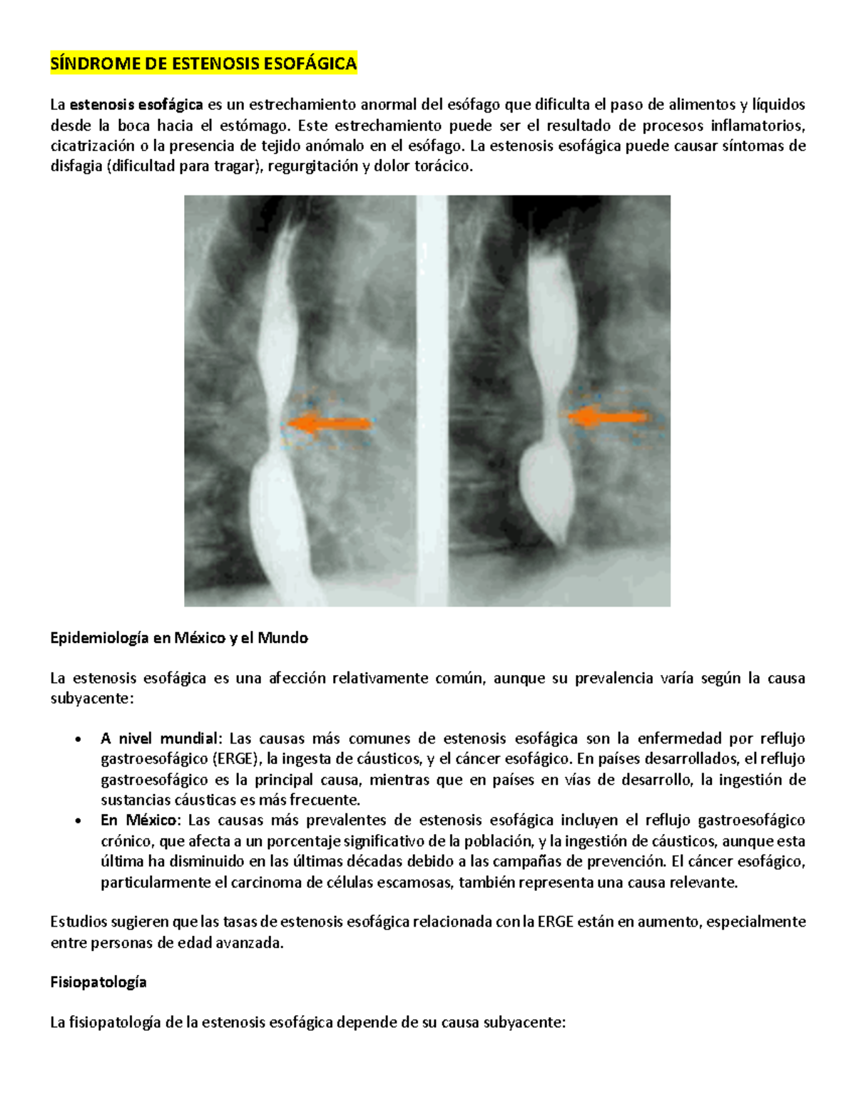 sibsc-sindromes-digestivos-s-ndrome-de-estenosis-esof-gica-la