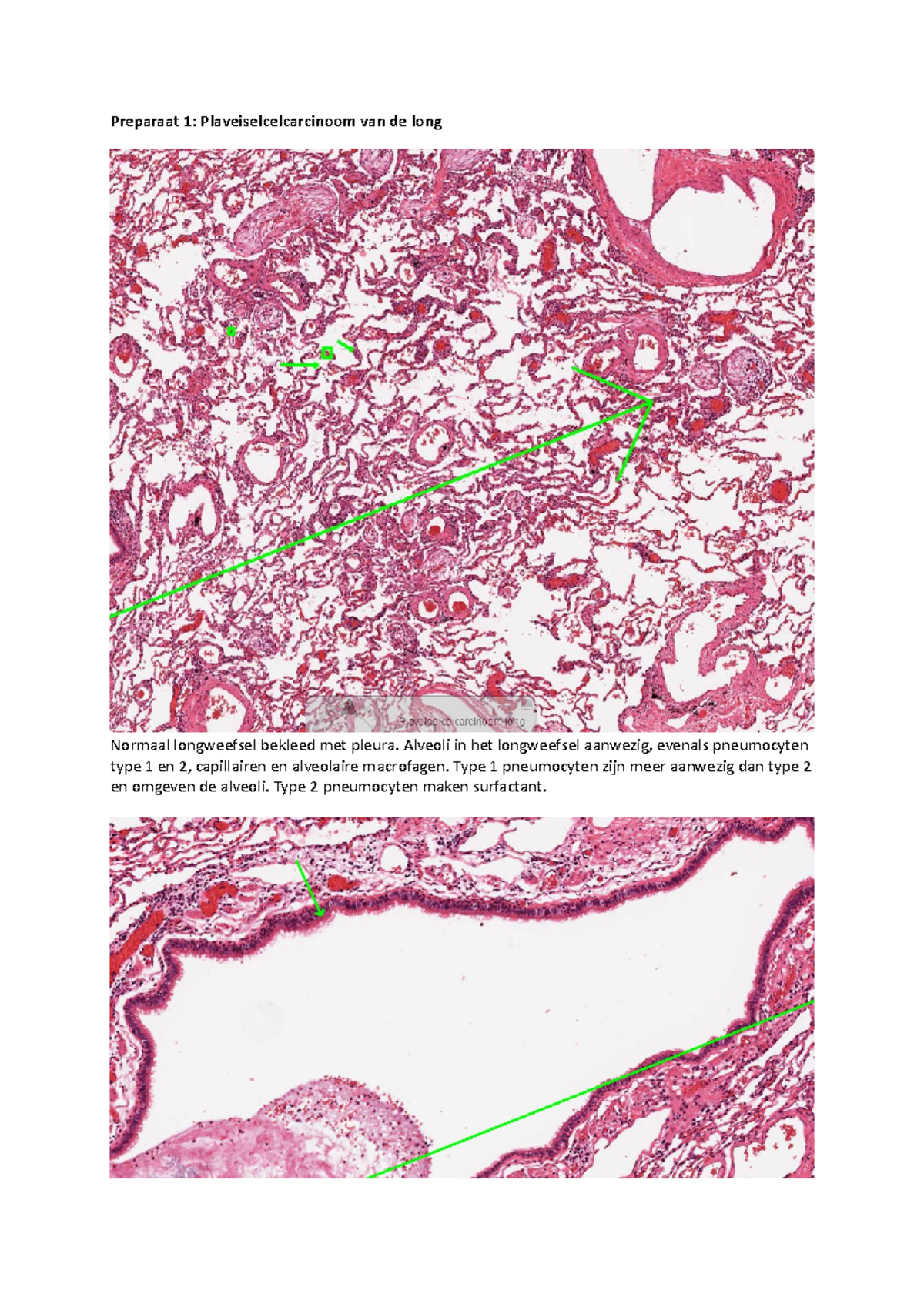 Practicum 2: Longen en Huid - Plaveiselcel- en Melanoomcarcinoom ...
