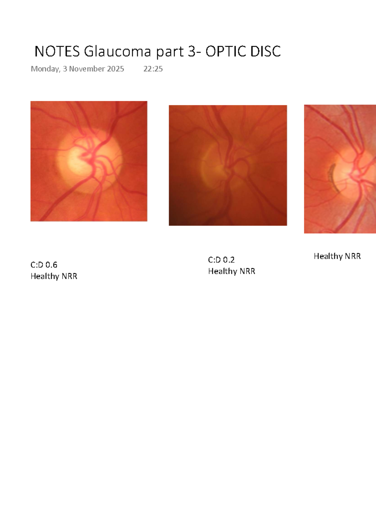 NOTES Glaucoma Part 3: Optic Disc Analysis - Studocu