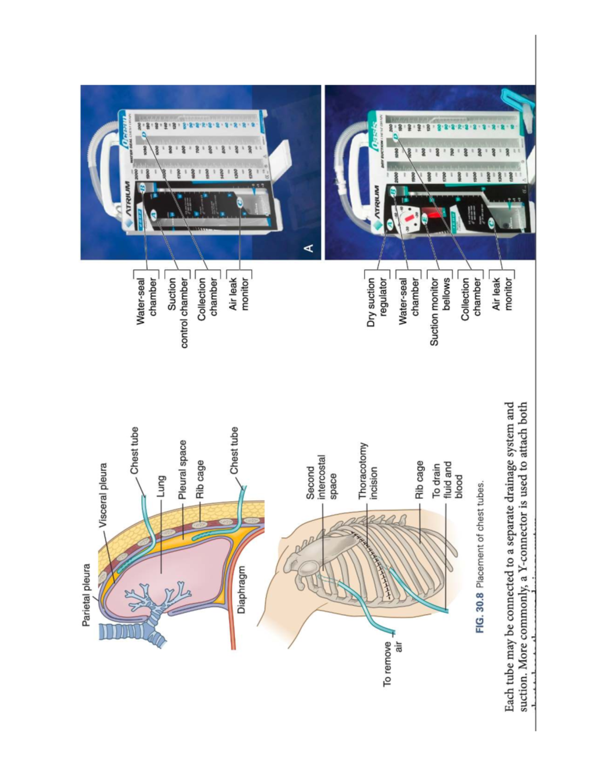 Chest Tube Atrium Diagram