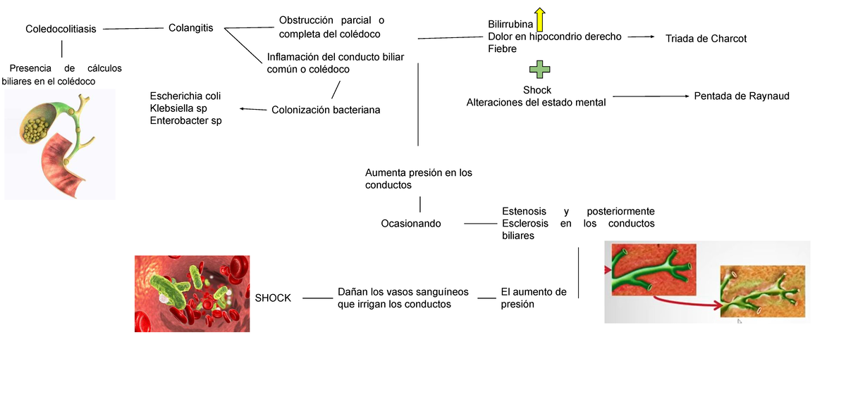 Coledocolitiasis - Coledocolitiasis Presencia de cálculos biliares en ...