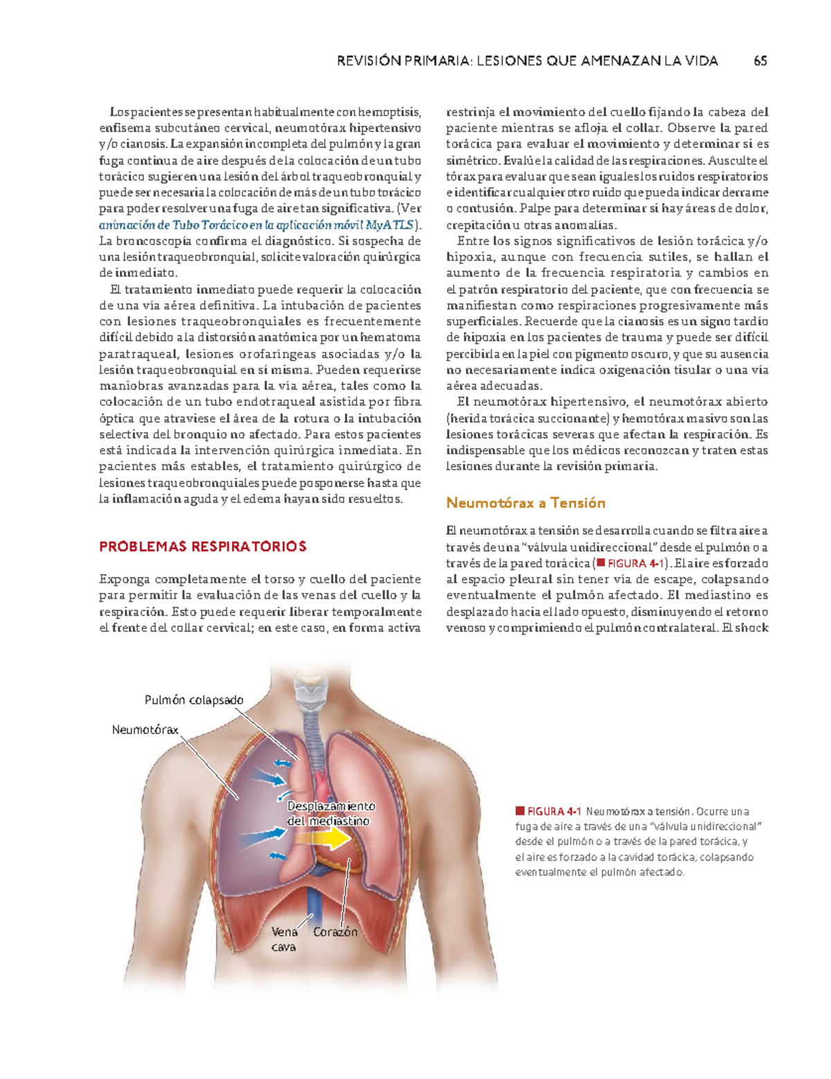 Revisión Primaria: Neumotórax y Hemotórax en ATLS 10ma Edición - Studocu