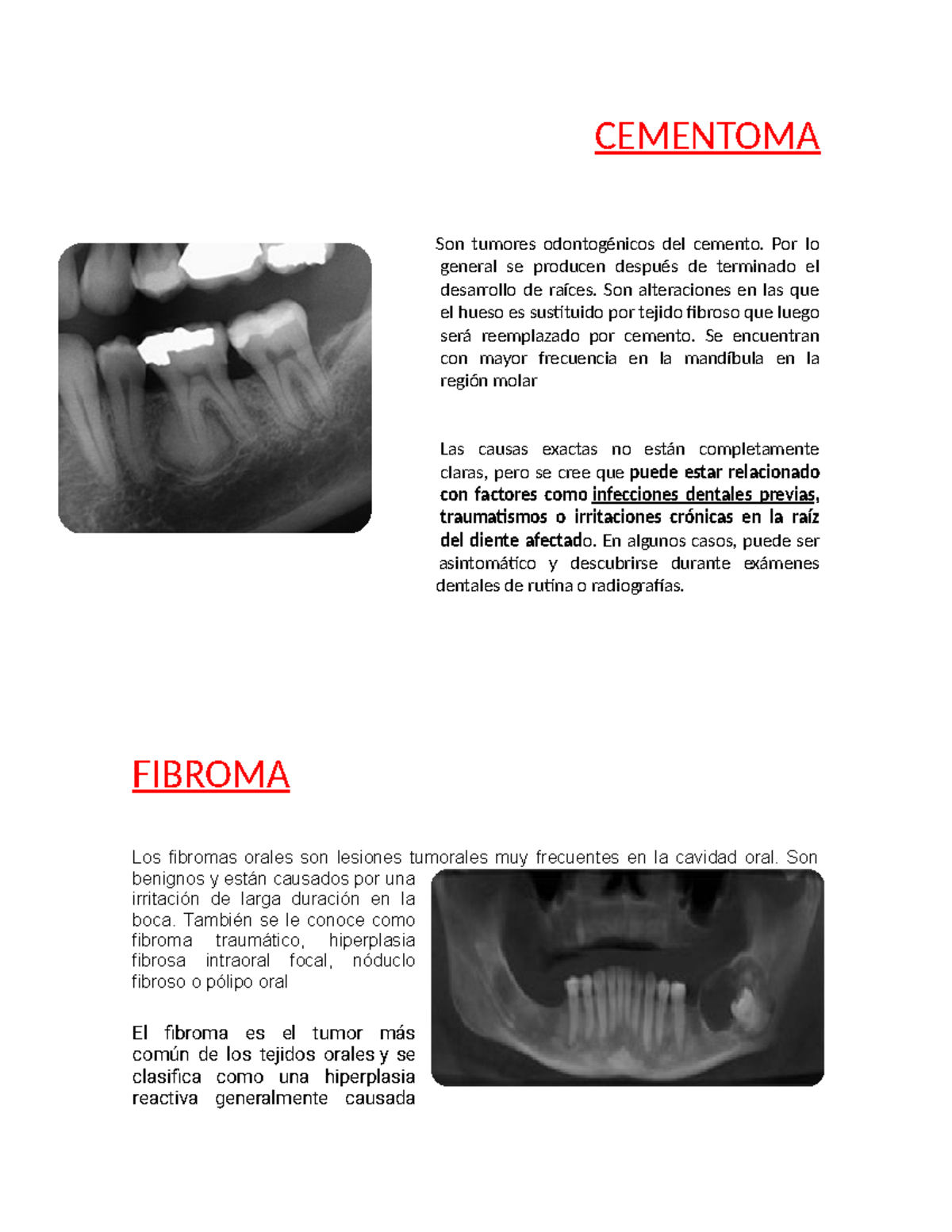Radiologia - Tumores Odontogénicos: Cementoma y Fibroma - Studocu
