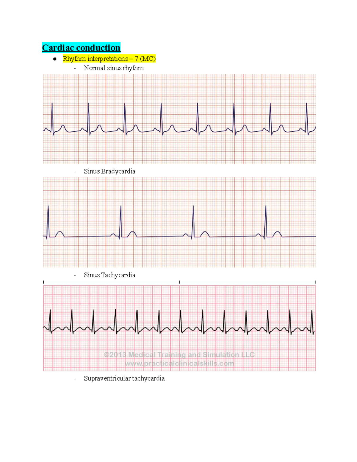 Adult Health Cardiac Final Exam Topics: Rhythm Interpretations ...